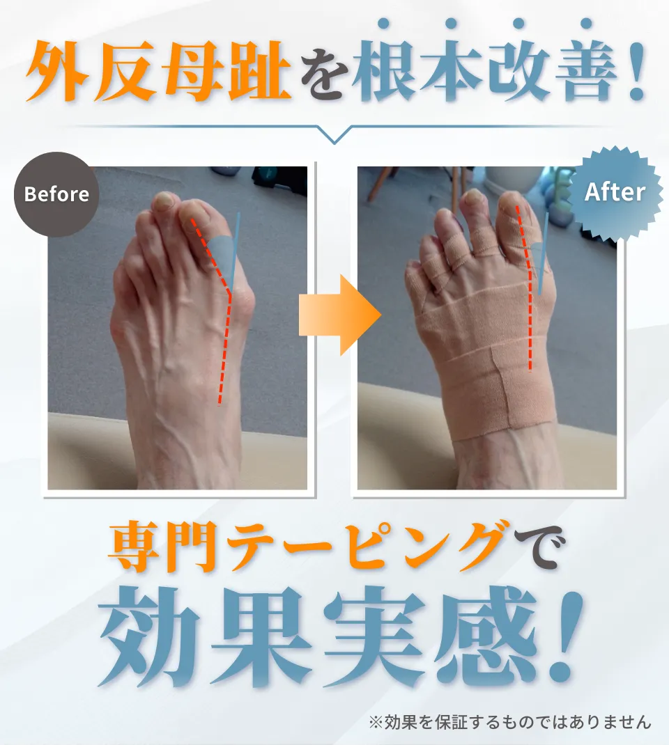 外反母趾のビフォーアフター